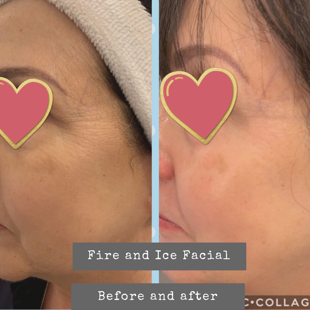 Chemical Peels Cardiff Skin Care Clinic Cardiff