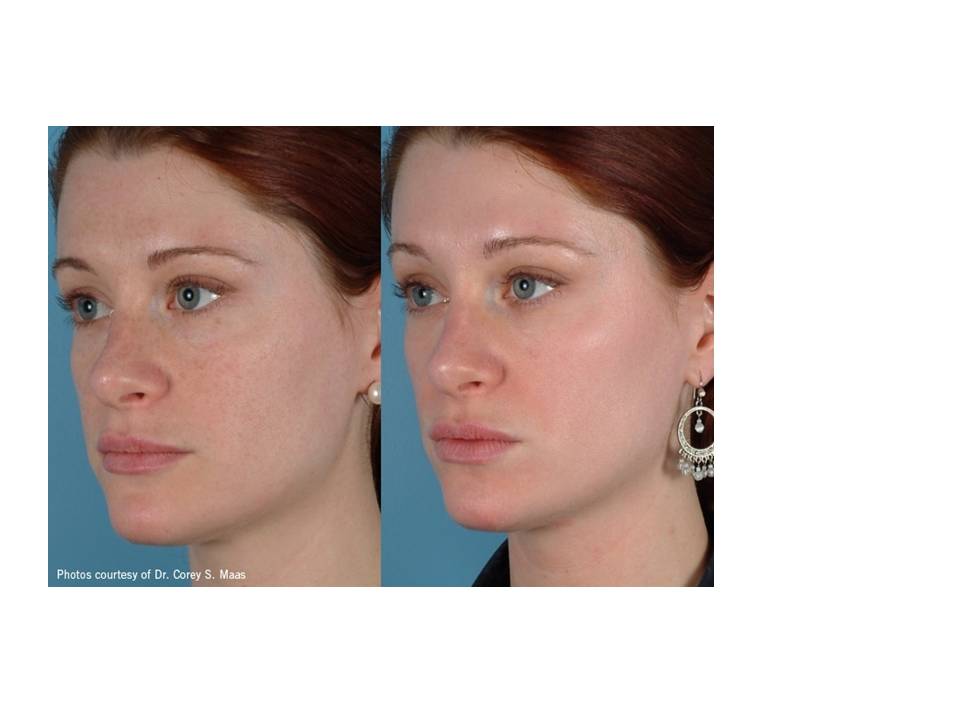 Before & After Cardiff Skin Care Clinic Cardiff