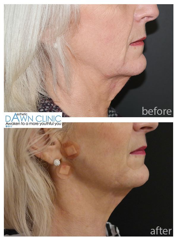 PDO Thread Lift Cardiff Skin Care Clinic Cardiff